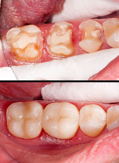 Springfield Gentle Dental | Ceramic Crowns, Implant Dentistry and Dental Cleanings