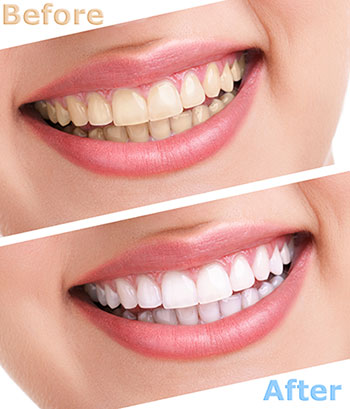 Springfield Gentle Dental | All-on-4 reg , Invisalign reg  and Ceramic Crowns